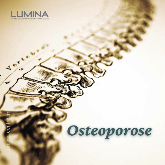 Read more about the article Osteoporose
