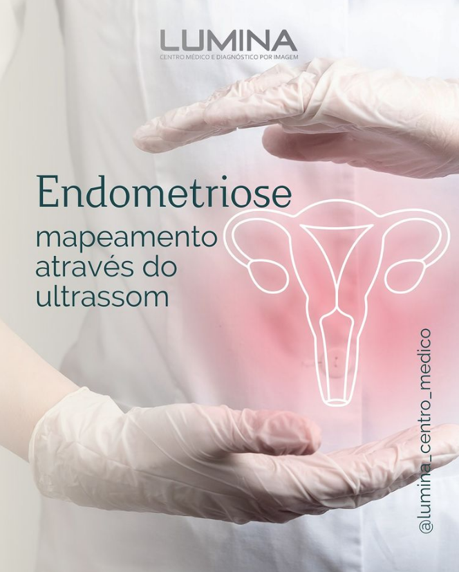 Read more about the article Endometriose – Mapeamento através do ultrassom