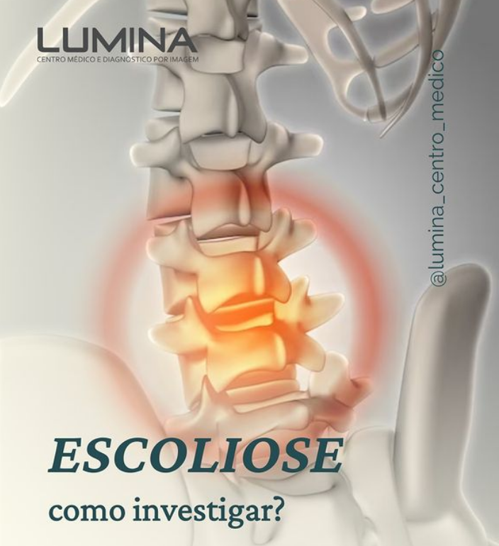 Read more about the article Escoliose