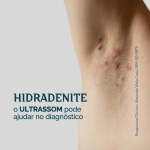 Hidradenite: O ultrassom pode ajudar no diagnóstico?