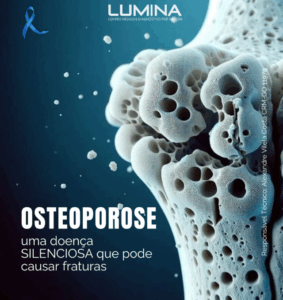 Read more about the article Osteoporose: conheça, previna e cuide dos seus ossos