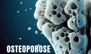 Osteoporose: conheça, previna e cuide dos seus ossos