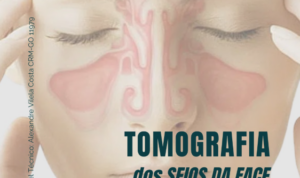 Tomografia dos Seios da Face: quando é indicada e o que ela revela