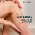 Suas varizes precisam de atenção