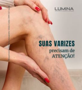Leia mais sobre o artigo Suas varizes precisam de atenção