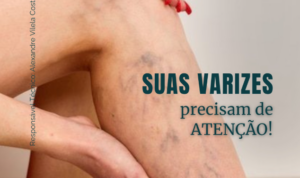 Suas varizes precisam de atenção