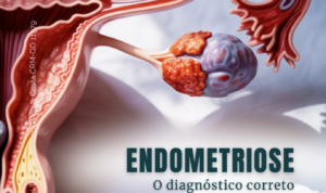 Endometriose: entenda os sinais e cuide da sua saúde
